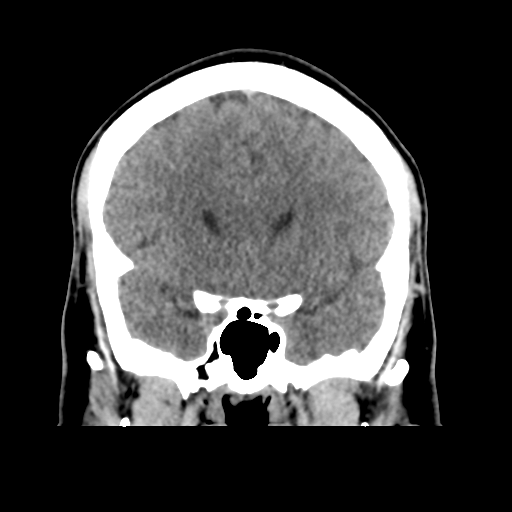 Cerebral arteriovenous malformation (Spetzler-Martin grade 2) (Radiopaedia 41262-44076 Coronal non-contrast 22).png