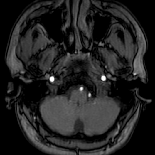 Cerebral arteriovenous malformation at posterior body of corpus callosum (Radiopaedia 74111-84925 Axial MRA 17).jpg