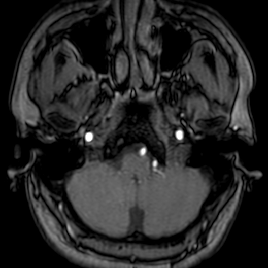 Cerebral arteriovenous malformation at posterior body of corpus callosum (Radiopaedia 74111-84925 Axial MRA 20).jpg