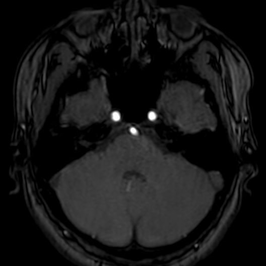 Cerebral arteriovenous malformation at posterior body of corpus callosum (Radiopaedia 74111-84925 Axial MRA 44).jpg