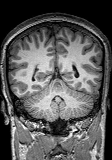 Cerebral arteriovenous malformation at posterior body of corpus callosum (Radiopaedia 74111-84925 Coronal T1 241).jpg