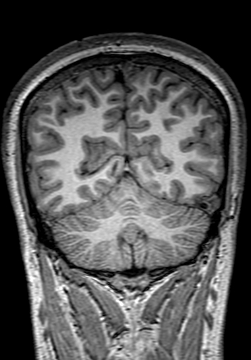 Cerebral arteriovenous malformation at posterior body of corpus callosum (Radiopaedia 74111-84925 Coronal T1 267).jpg