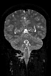 Cerebral arteriovenous malformation at posterior body of corpus callosum (Radiopaedia 74111-84925 Coronal T2 126).jpg