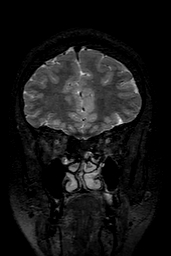 Cerebral arteriovenous malformation at posterior body of corpus callosum (Radiopaedia 74111-84925 Coronal T2 36).jpg