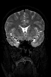 Cerebral arteriovenous malformation at posterior body of corpus callosum (Radiopaedia 74111-84925 Coronal T2 63).jpg
