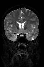 Cerebral arteriovenous malformation at posterior body of corpus callosum (Radiopaedia 74111-84925 Coronal T2 68).jpg