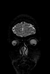 Cerebral arteriovenous malformation at posterior body of corpus callosum (Radiopaedia 74111-84925 Coronal T2 7).jpg