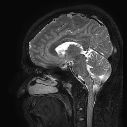 Cerebral arteriovenous malformation at posterior body of corpus callosum (Radiopaedia 74111-84925 Sagittal T2 60).jpg