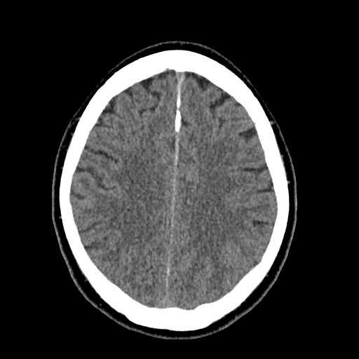 Cerebral arteriovenous malformation with lobar hemorrhage (Radiopaedia 35598-37117 Axial non-contrast 40).jpg