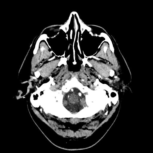 Cerebral arteriovenous malformation with lobar hemorrhage (Radiopaedia 35598-57216 A 6).jpg