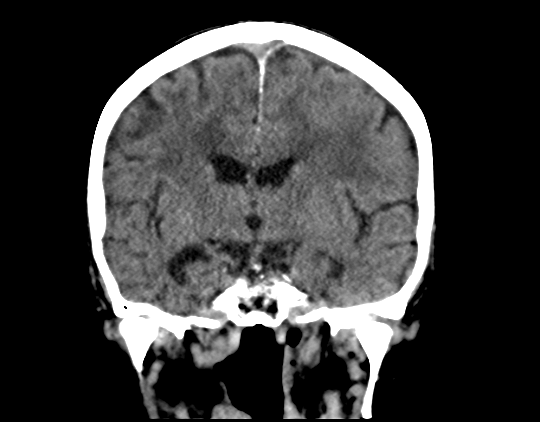 File:Cerebral arteriovenous malformation with lobar hemorrhage (Radiopaedia 44725-48510 Coronal non-contrast 26).png