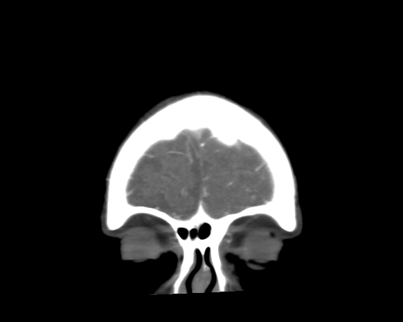 Cerebral arteriovenous malformation with lobar hemorrhage (Radiopaedia 44725-48511 A 7).png