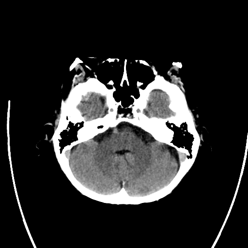 File:Cerebral arteriovenous malformation with lobar hemorrhage (Radiopaedia 44725-48512 Axial non-contrast 12).png