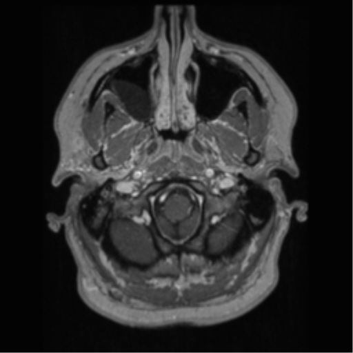 File:Cerebral cavernoma and development venous anomaly (Radiopaedia 37603-39482 Axial T1 C+ 10).png