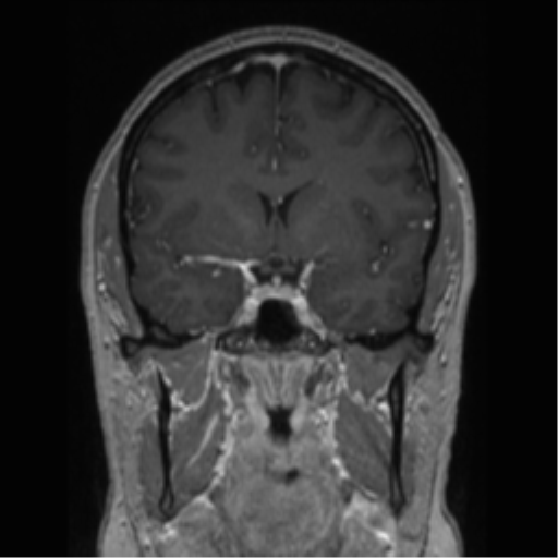 Cerebral cavernoma and development venous anomaly (Radiopaedia 37603-39482 Coronal T1 C+ 58).png
