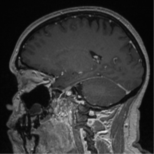Cerebral cavernoma and development venous anomaly (Radiopaedia 37603-39482 Sagittal T1 C+ 38).png
