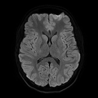 Cerebral cavernous venous malformation (Radiopaedia 70008-80021 Axial DWI 47).jpg