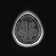 File:Cerebral cavernous venous malformation (Radiopaedia 70008-80021 Axial T1 84).jpg