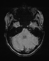 Cerebral cavernous venous malformation (Radiopaedia 70008-80021 I 18).jpg