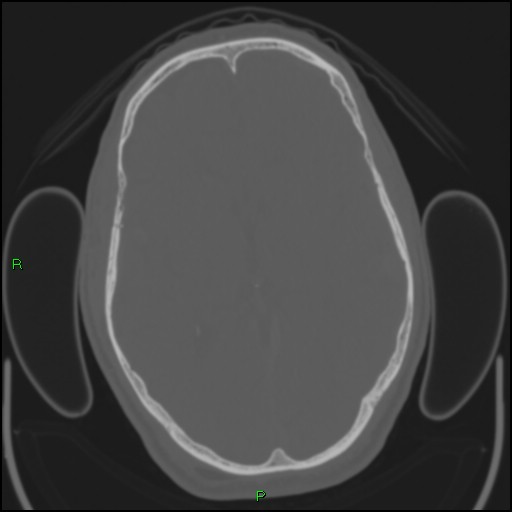 Cerebral contusions (Radiopaedia 33868-35039 Axial bone window 101).jpg