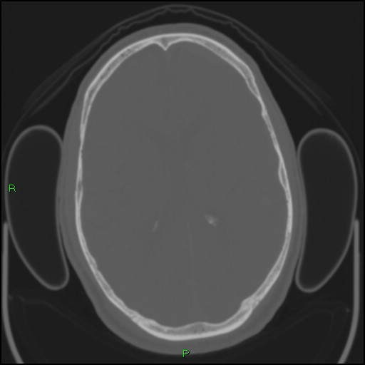 Cerebral contusions (Radiopaedia 33868-35039 Axial bone window 121).jpg