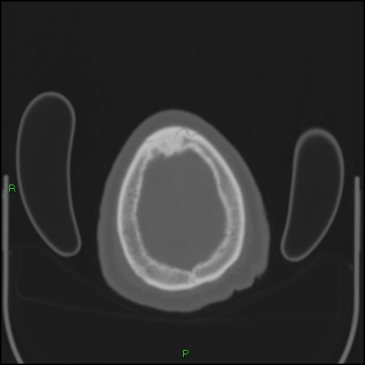Cerebral contusions (Radiopaedia 33868-35039 Axial bone window 206).jpg