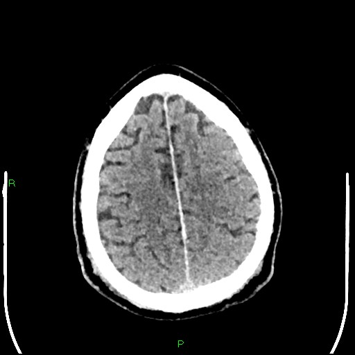 Cerebral contusions (Radiopaedia 33868-35039 Axial non-contrast 175).jpg
