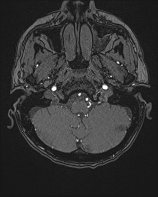 Cerebral embolic infarcts (embolic shower) (Radiopaedia 72391-82921 Axial MRA 1).jpg
