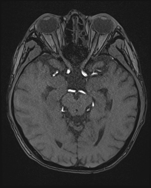 Cerebral embolic infarcts (embolic shower) (Radiopaedia 72391-82921 Axial MRA 64).jpg
