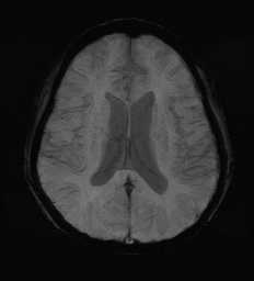 Cerebral embolic infarcts (embolic shower) (Radiopaedia 72391-82921 Axial SWI 43).jpg