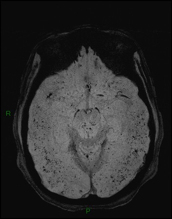 Cerebral fat embolism (Radiopaedia 35022-36525 Axial SWI 8).jpg