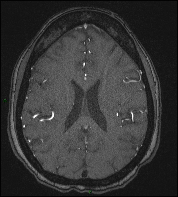 Cerebral fat embolism (Radiopaedia 35022-36525 Axial TOF 131).jpg
