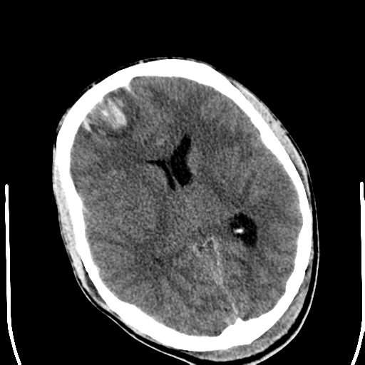File:Cerebral hemorrhagic contusions- temporal evolution (Radiopaedia 40224-42752 Axial non-contrast 14).png
