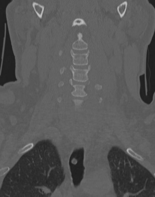 Cerebral hemorrhagic contusions and cervical spine fractures (Radiopaedia 32865-33841 Coronal bone window 21).jpg