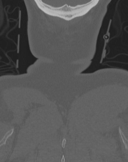 Cerebral hemorrhagic contusions and cervical spine fractures (Radiopaedia 32865-33841 Coronal bone window 82).jpg