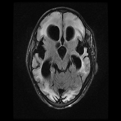 File:Cerebral manifestations of mucopolysaccharidosis type I (Radiopaedia 59171-66487 Axial FLAIR 8).jpg