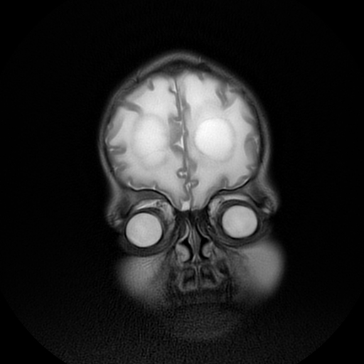 File:Cerebral manifestations of mucopolysaccharidosis type I (Radiopaedia 59171-66487 Coronal T2 1).jpg