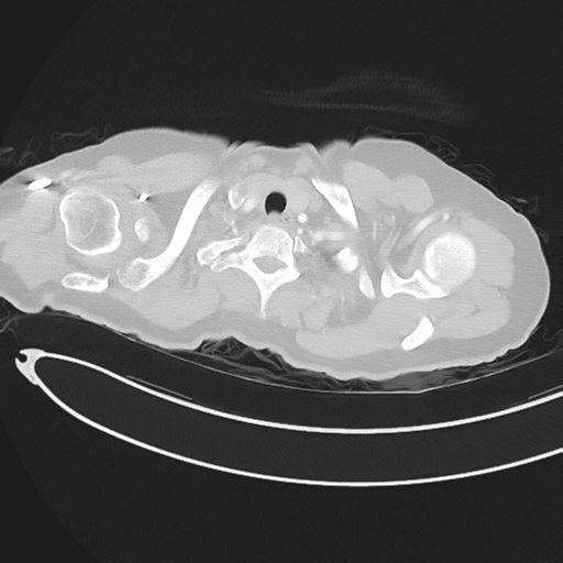 Cerebral metastases (Radiopaedia 33041-34055 Axial lung window 6).png
