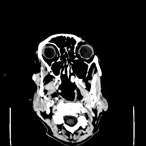 Cerebral metastases - breast primary (Radiopaedia 77653-89857 Axial C+ delayed 3).jpg