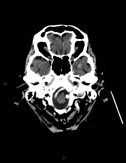 Cerebral metastases - ependymal and parenchymal (Radiopaedia 79877-93131 Axial C+ delayed 10).jpg