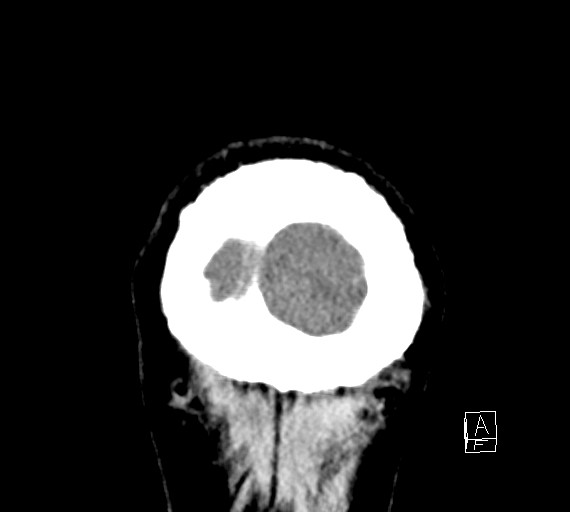 Cerebral metastases - testicular choriocarcinoma (Radiopaedia 84486-99855 Coronal C+ delayed 61).jpg