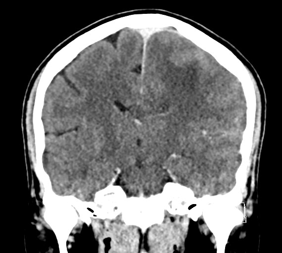 Cerebral metastases - testicular choriocarcinoma (Radiopaedia 84486-99855 D 33).jpg