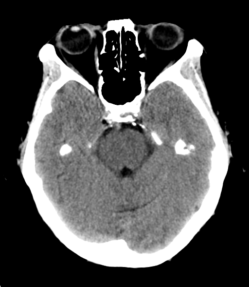 File:Cerebral metastasis (Radiopaedia 46744-51247 Axial non-contrast 10).png