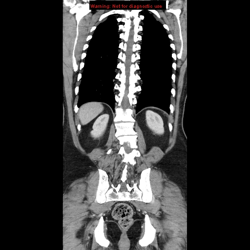File:Cerebral metastasis - colorectal carcinoma (Radiopaedia 8581-83548 A 65).jpg