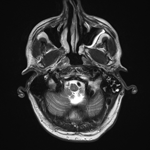 File:Cerebral metastasis - melanoma (Radiopaedia 54718-60954 Axial T2 4).png