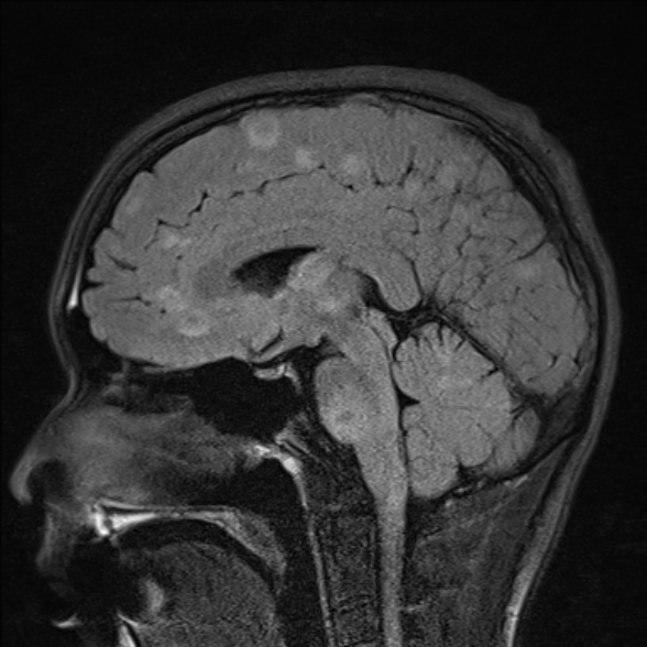 File:Cerebral toxoplasmosis (Radiopaedia 53993-60132 Sagittal FLAIR 14).jpg