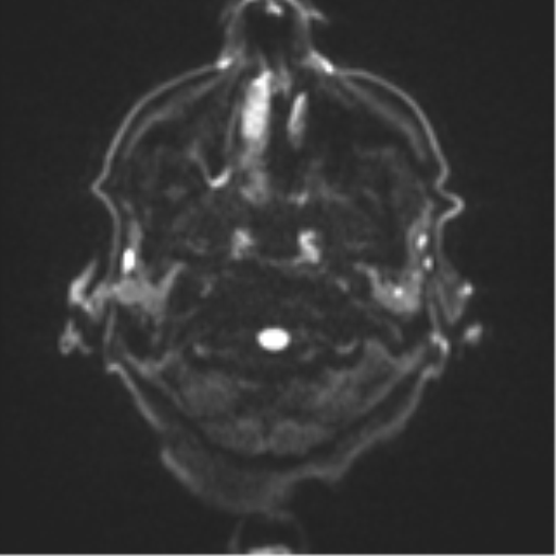Cerebral toxoplasmosis (Radiopaedia 54575-60804 Axial DWI 36).png