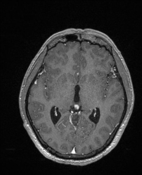 Cerebral toxoplasmosis (Radiopaedia 85779-101597 Axial T1 C+ 80).jpg