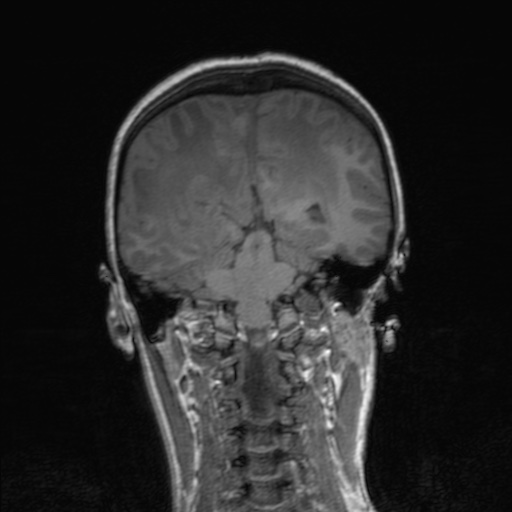 Cerebral tuberculosis with dural sinus invasion (Radiopaedia 60353-68090 Coronal T1 122).jpg