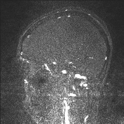 Cerebral tuberculosis with dural sinus invasion (Radiopaedia 60353-68090 Sagittal MRV 97).jpg